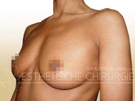 Brustvergrößerung Voher / Nachher